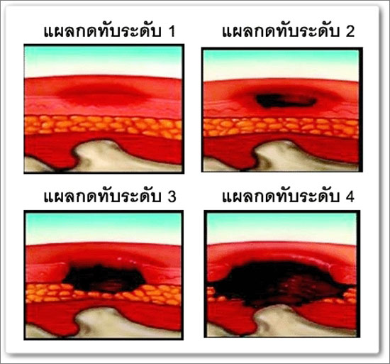 รปแผลกดทบ