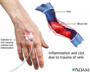 Phlebitis-1-300x240