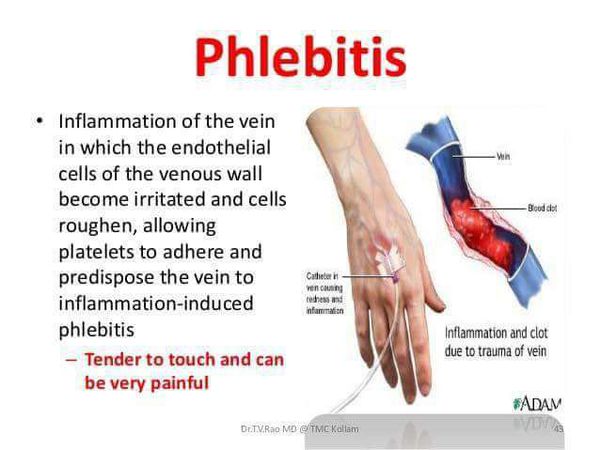 Phlebitis